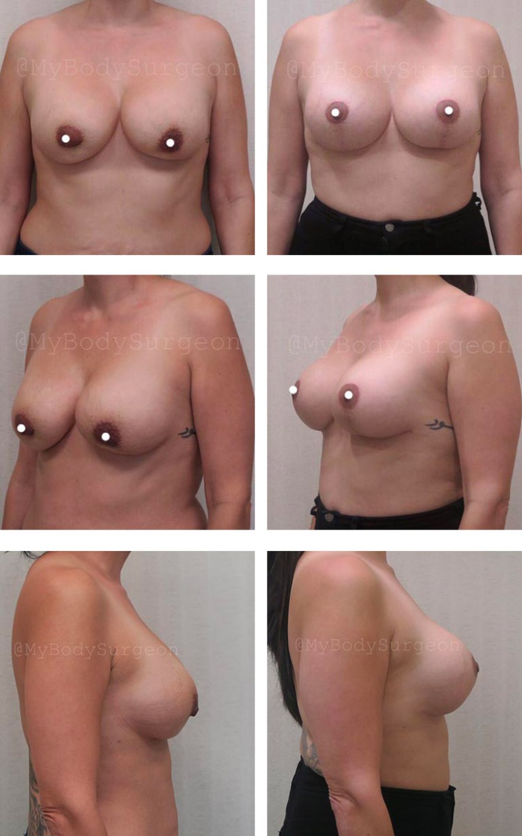 how much is a breast lift in houston